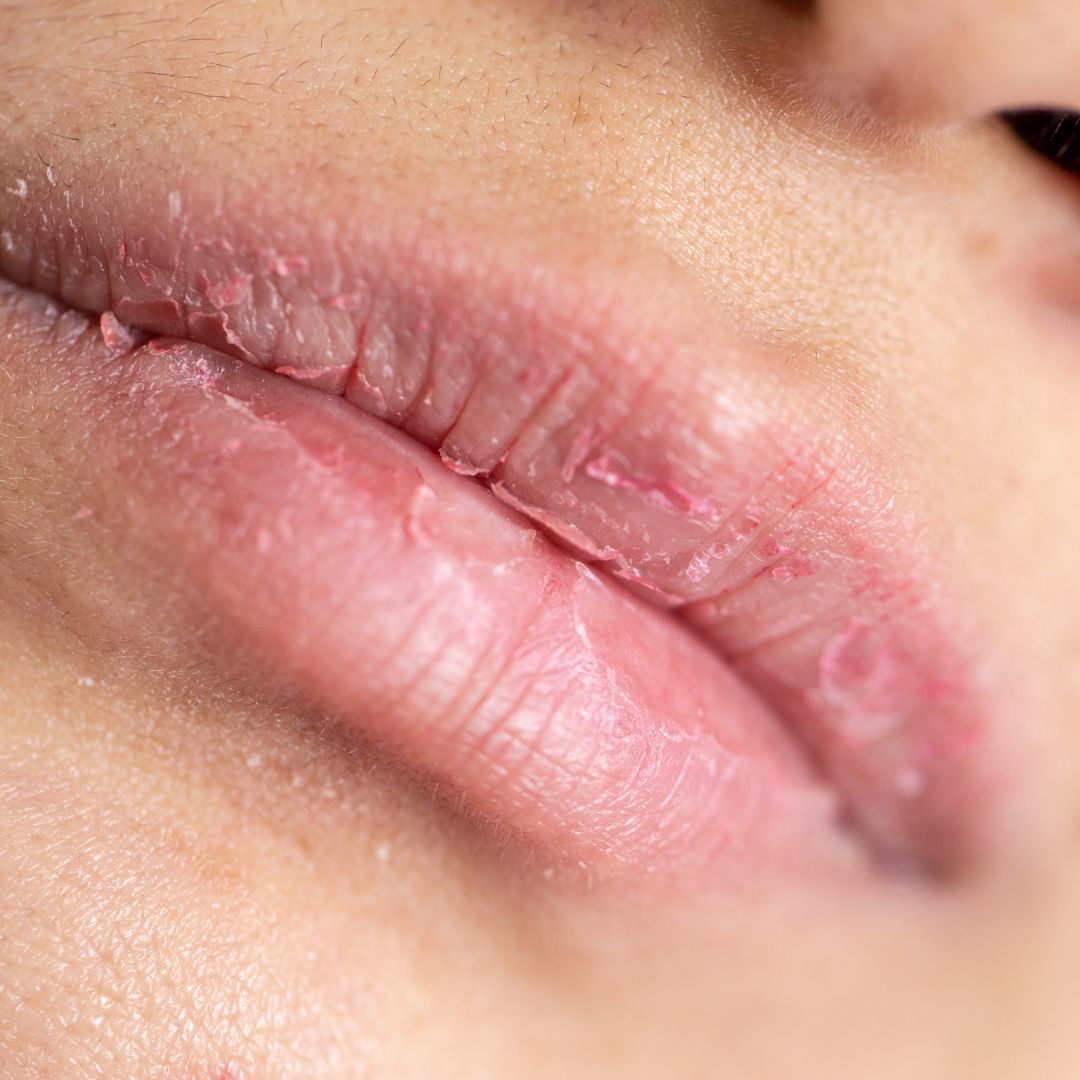 Mundtrockenheit und Schlaf