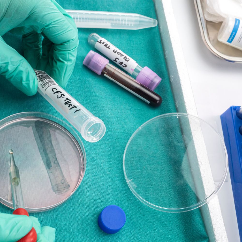 Das Sjögren-Syndrom ist eine komplexe Autoimmunerkrankung, die weit über trockene Augen und einen trockenen Mund hinausgeht.