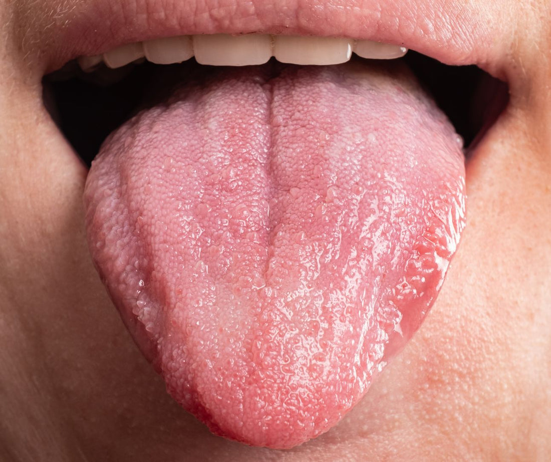 Mundsoor ist eine häufige Infektion der Mundschleimhaut, die durch Hefepilze – meist&nbsp;Candida albicans – verursacht wird. 