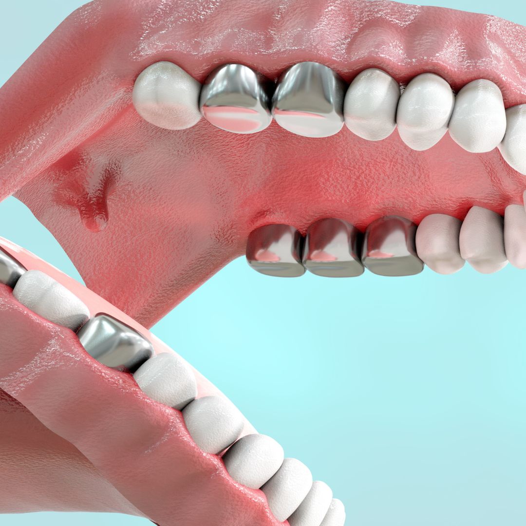 Amalgam und andere toxische Substanzen können bei empfindlichen Personen zur Entstehung oder Verstärkung von Mundtrockenheit beitragen.