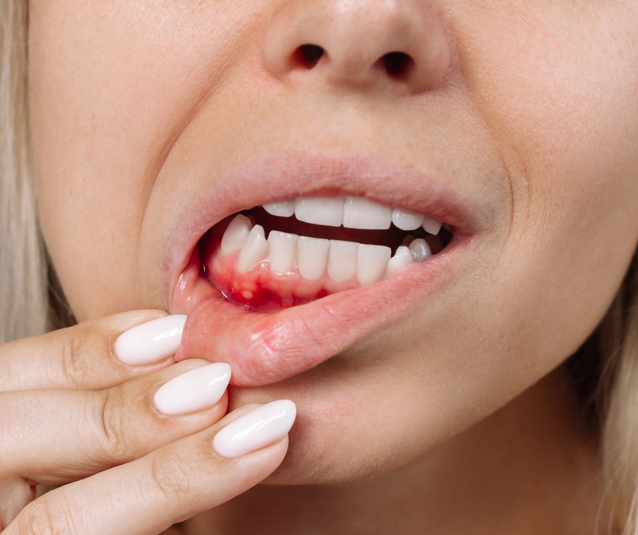 Mukositis ist eine häufige und oft belastende Nebenwirkung von Chemotherapien.